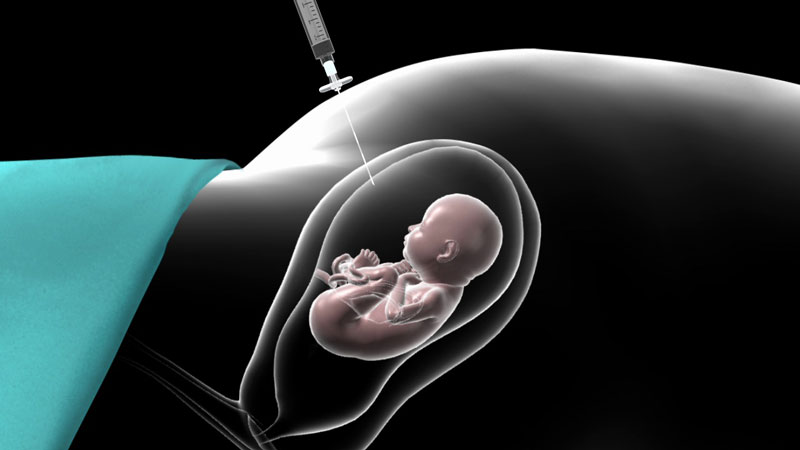 آزمایش آمنیوسنتز