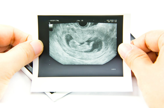 توقف-رشد-جنین-در-هفته-12-سقط
